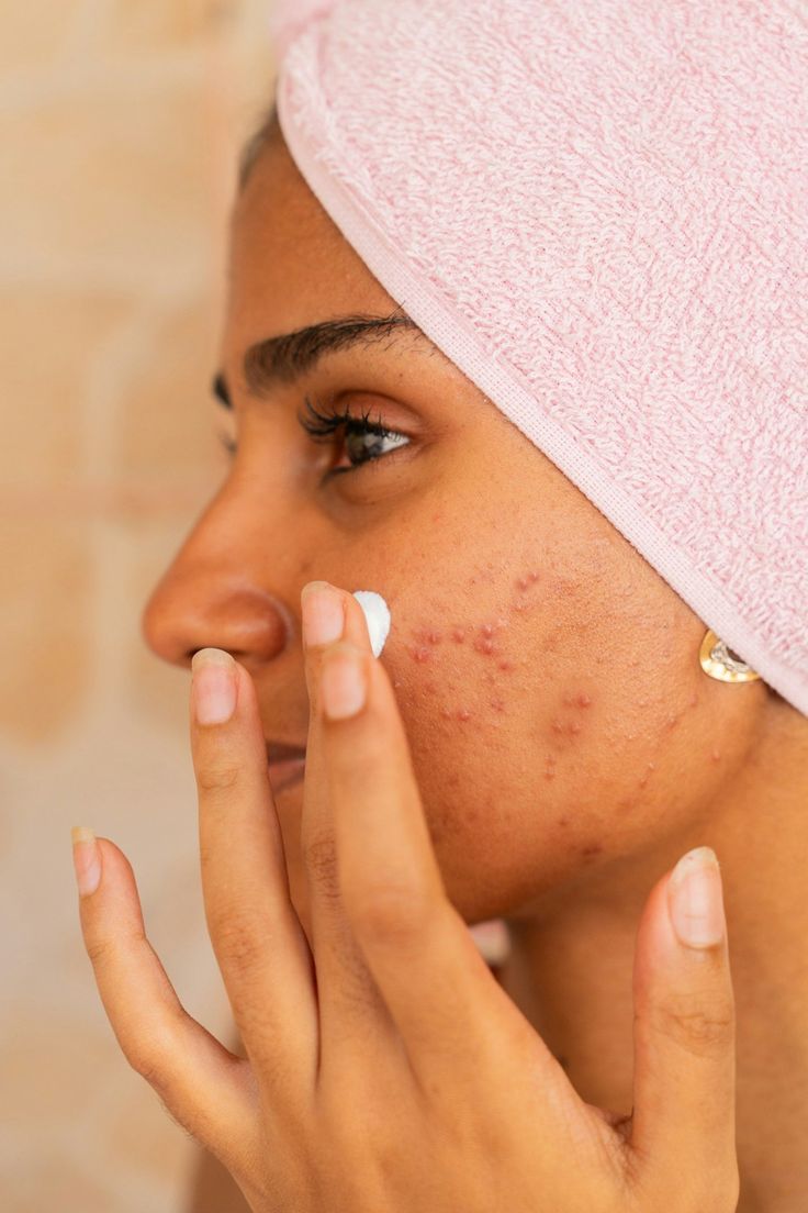 Oily/Acne